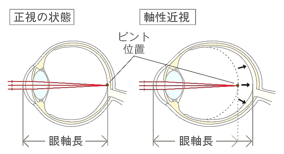 近視のメカニズム－いのうえ眼科