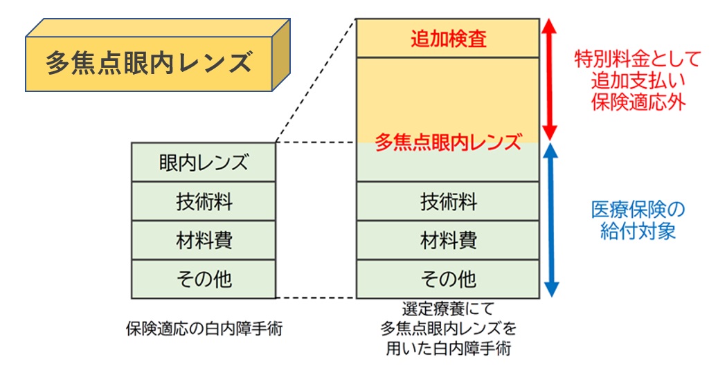 多焦点眼内レンズを用いた白内障手術と選定療養｜いのうえ眼科