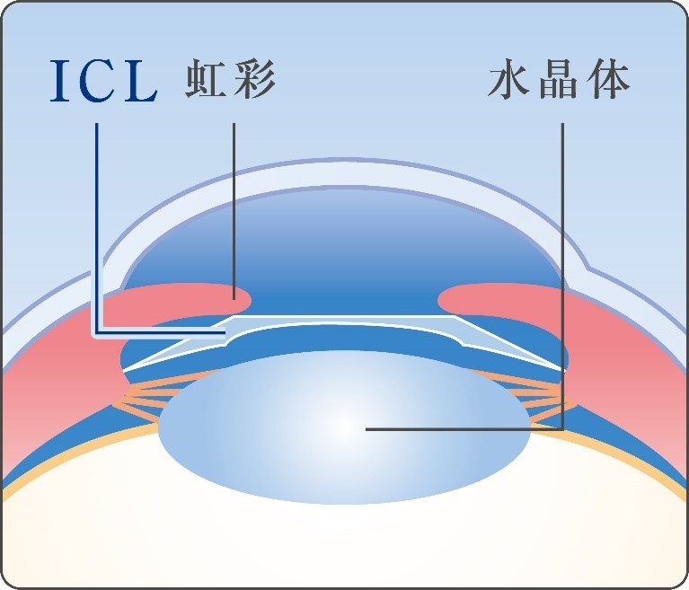 眼内コンタクトレンズ（ICL）-2｜いのうえ眼科