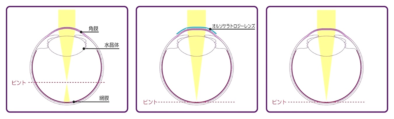 オルソケラトロジー｜いのうえ眼科